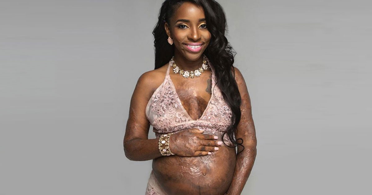 Mother Who Survived Third Degree Burns Puts Pregnant Belly On Display In Maternity Shoot 15 Years Later