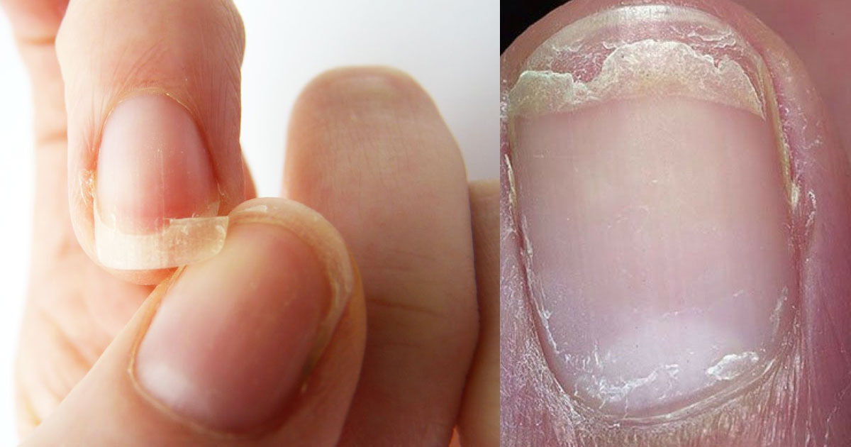Ever Wondered What Your Nails Reveal About Your Health?