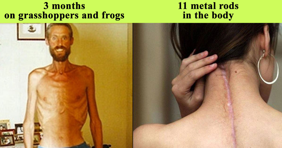 12 Stories Of People Whose Will To Live Was Stronger Than The Circumstances